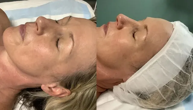 24K Gold Facial before and after