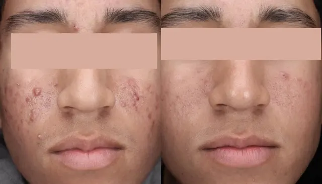 30 Minute Acne Facial before and after