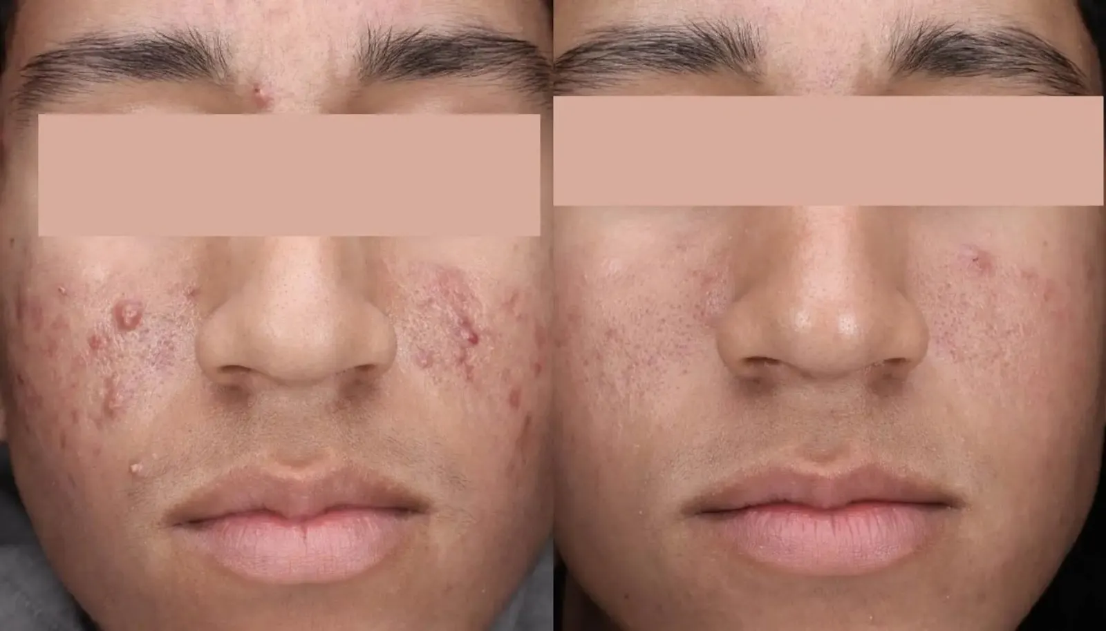 30 Minute Acne Facial — Before and After