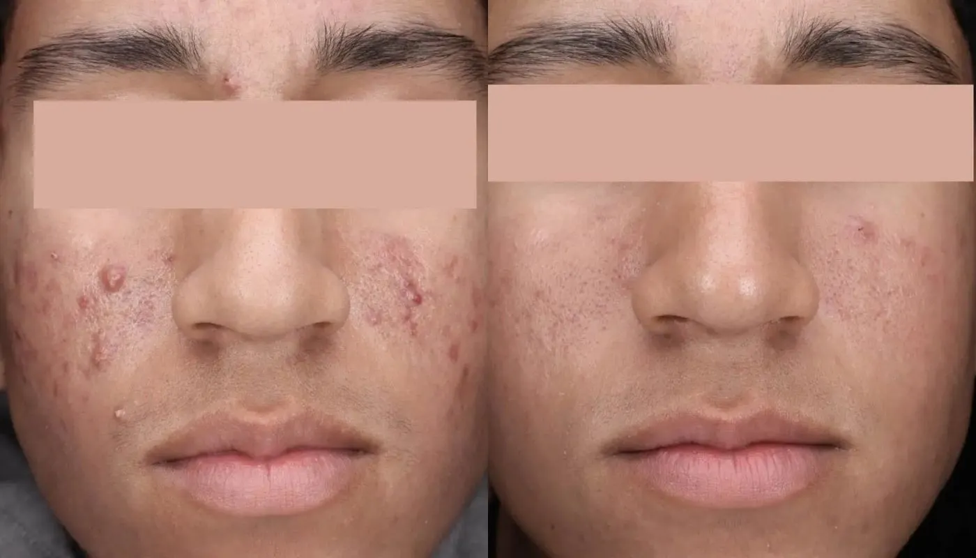 30 Minute Acne Facial — Before and After