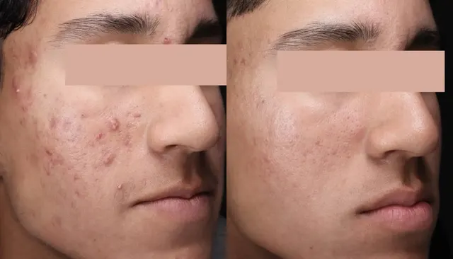 30 Minute Acne Facial before and after
