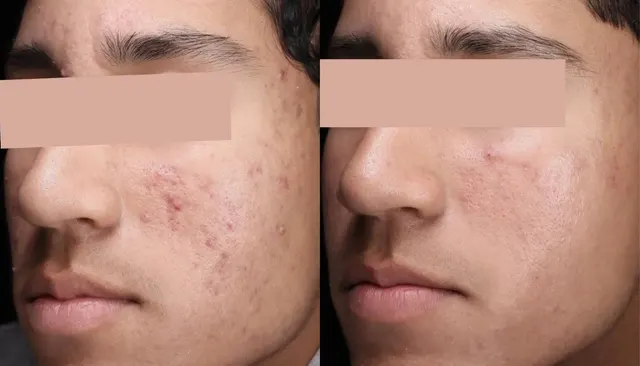 30 Minute Acne Facial before and after