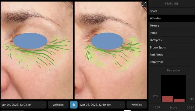 BBL before and after