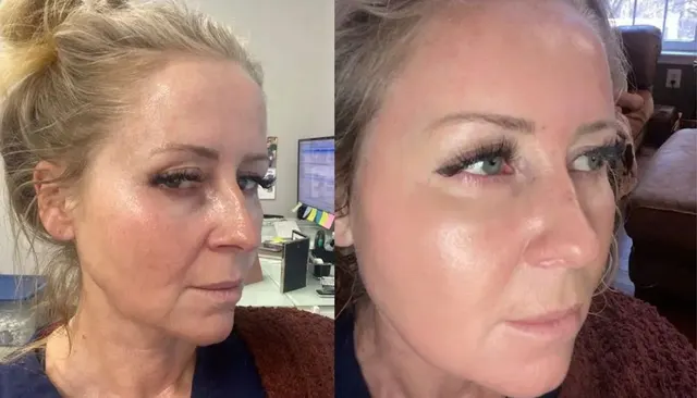BBL before and after