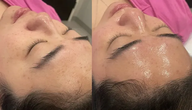 Chemical Peels before and after
