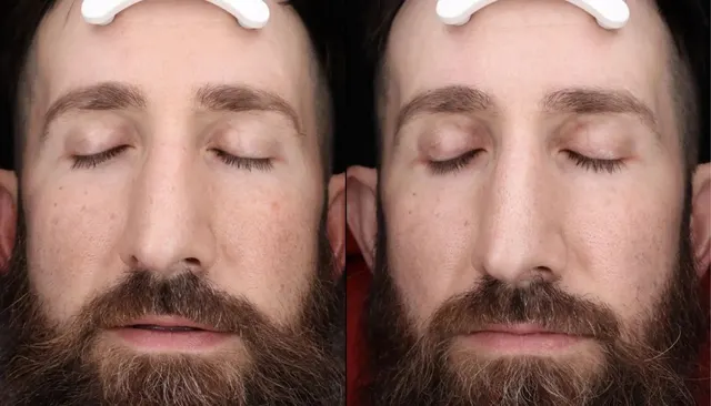 Chemical Peels before and after