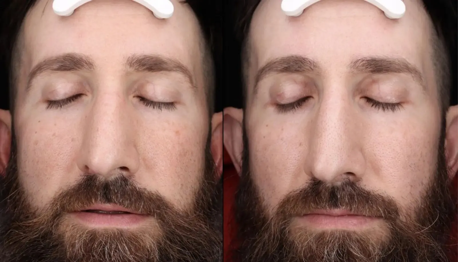 Chemical Peels — Before and After