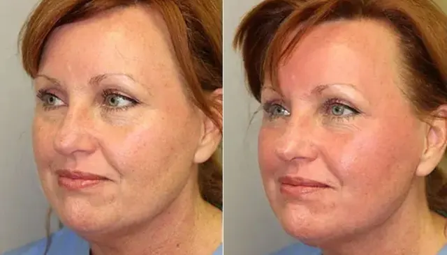Cool Peel before and after