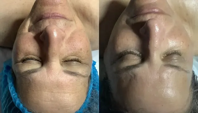 Custom Facial before and after
