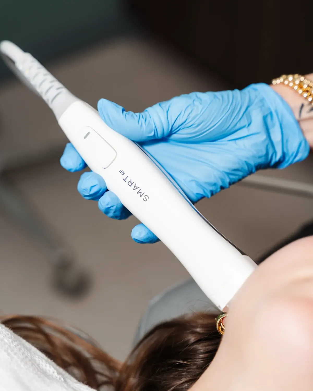 Gloved provider holding a Smart RF microneedling handpiece near a reclining patient