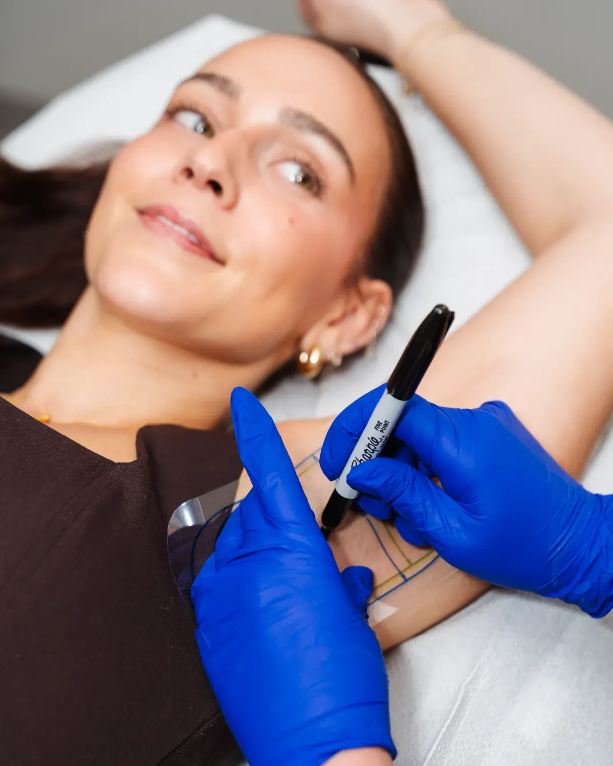 Before and after MiraDry underarm sweat reduction at Pura Vida Med Spa