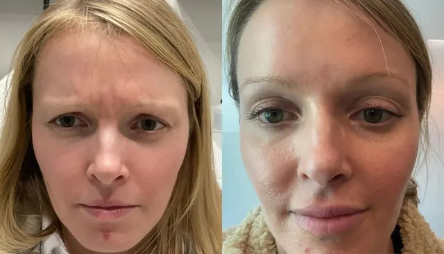 Daxxify before and after