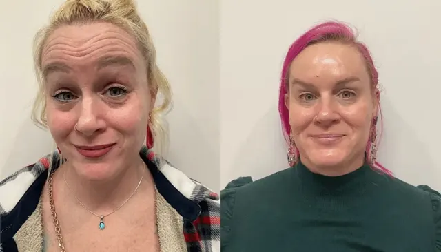 Daxxify before and after