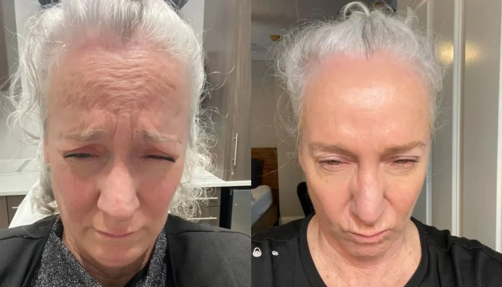Daxxify — Before and After