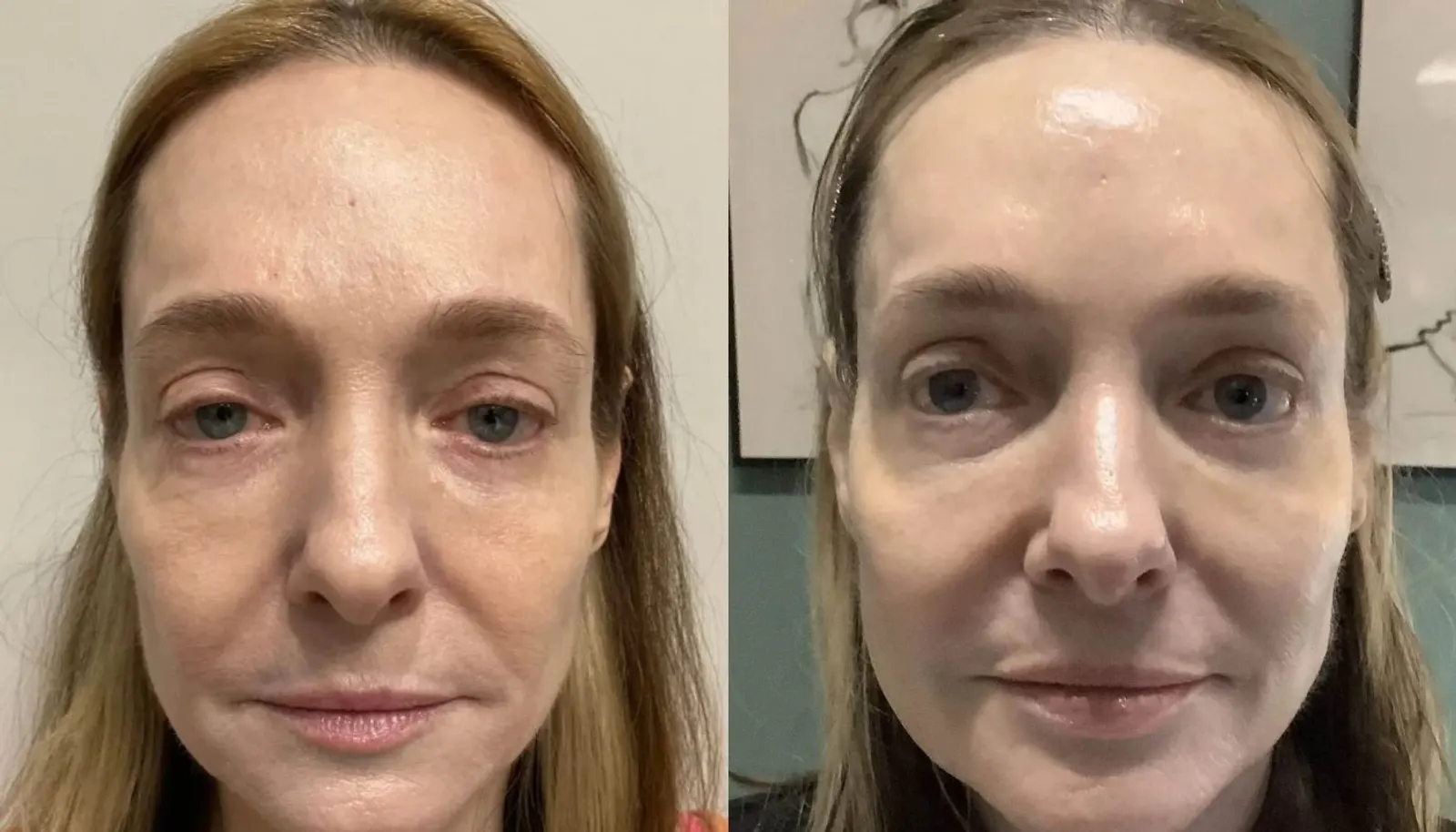 Daxxify — Before and After