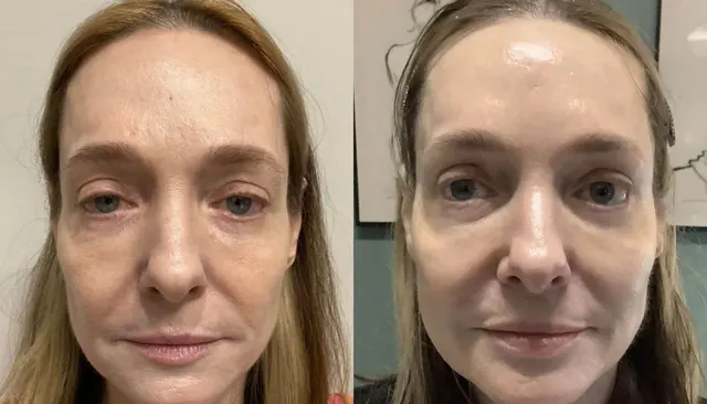 Daxxify before and after
