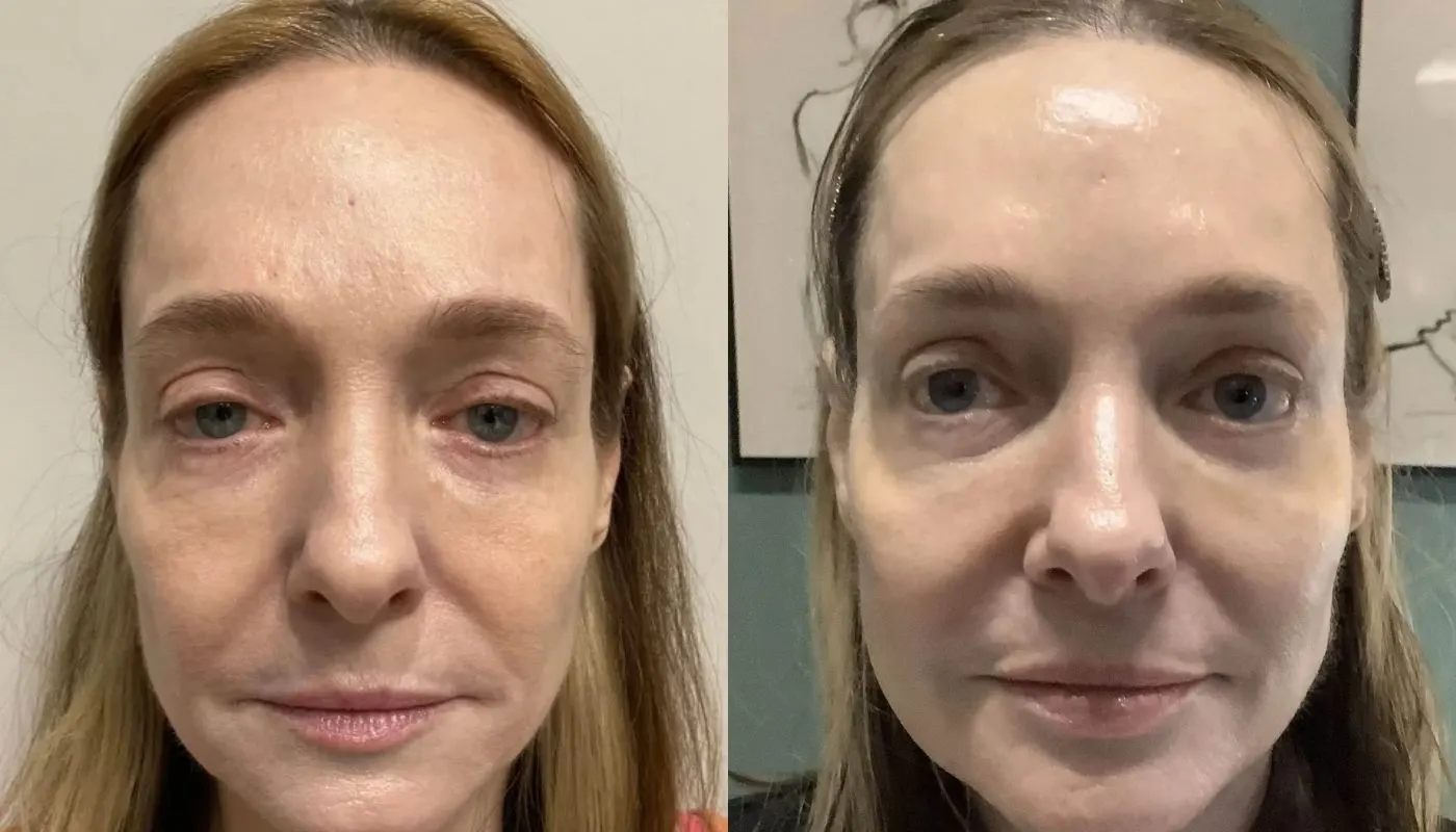 Daxxify — Before and After