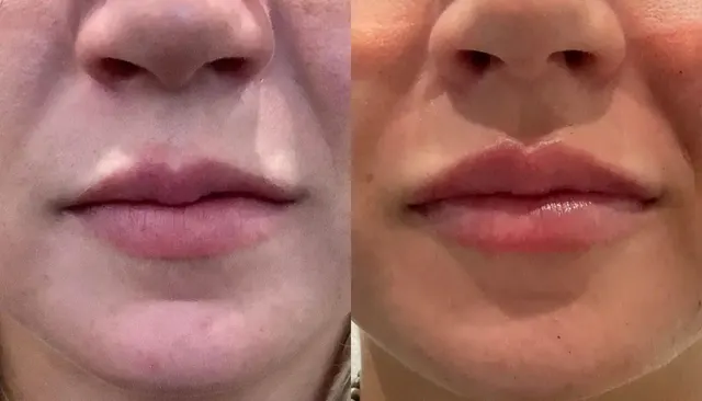 Dermal Fillers before and after