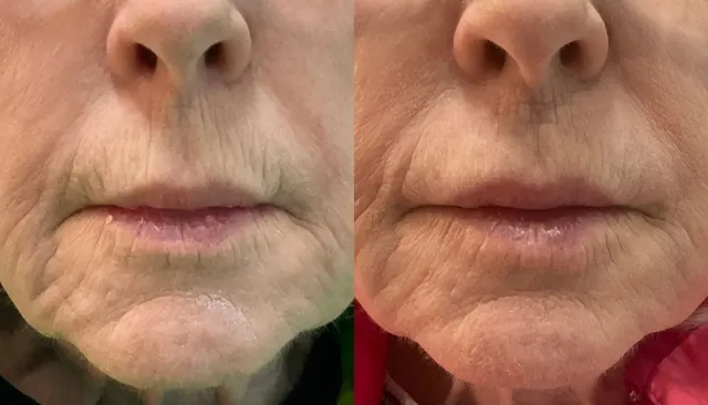 Dermal Fillers before and after
