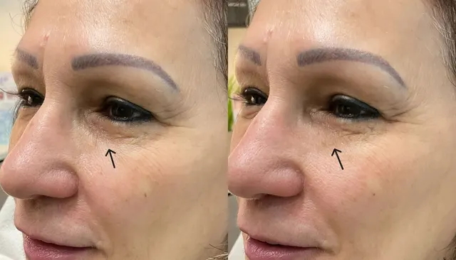 Dermal Fillers before and after