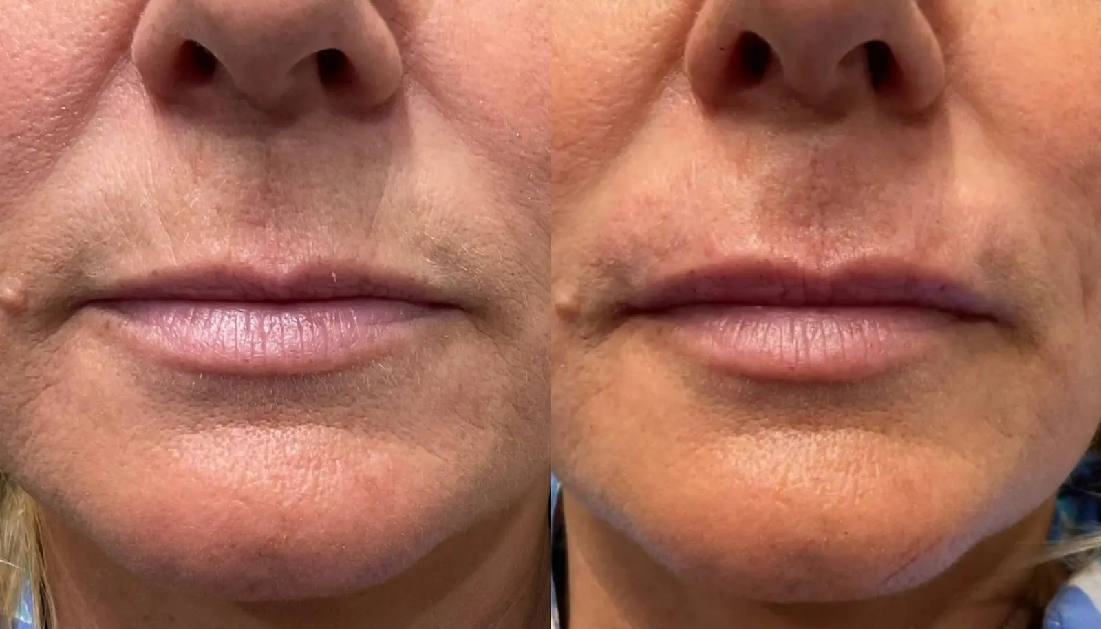 Dermal Fillers — Before and After