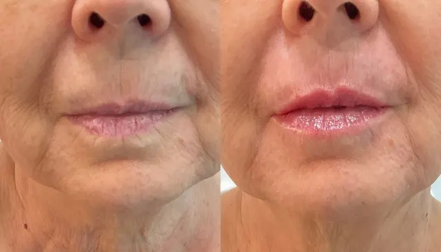 Dermal Fillers before and after
