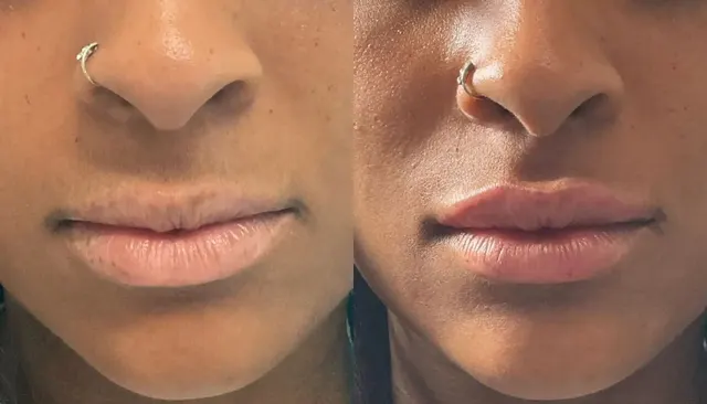 Dermal Fillers before and after