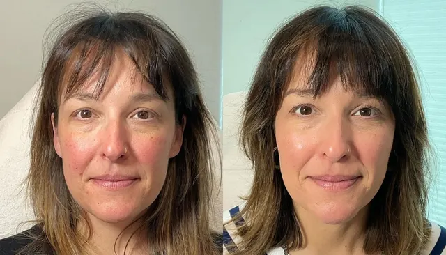 Dermal Fillers before and after