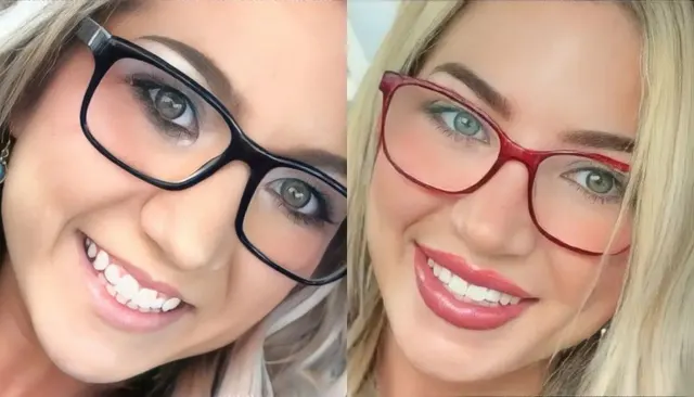 Dermal Fillers before and after
