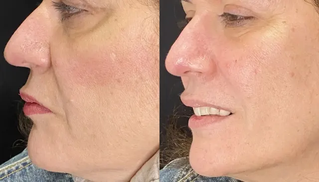Dermal Fillers before and after