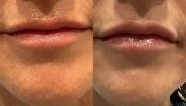 Dermal Fillers before and after