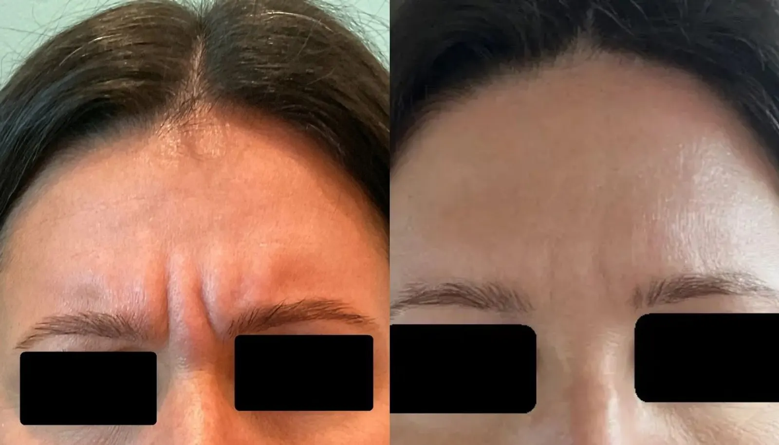 Dysport — Before and After
