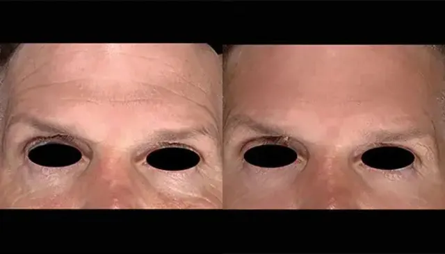 Emface before and after