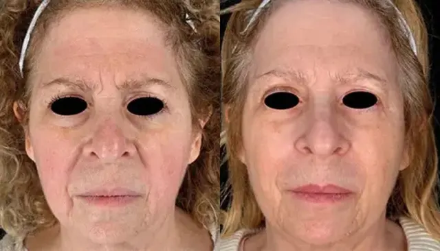 Emface before and after