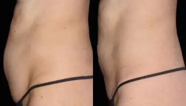 Emsculpt Neo before and after