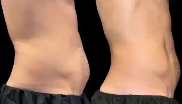 Emsculpt Neo before and after