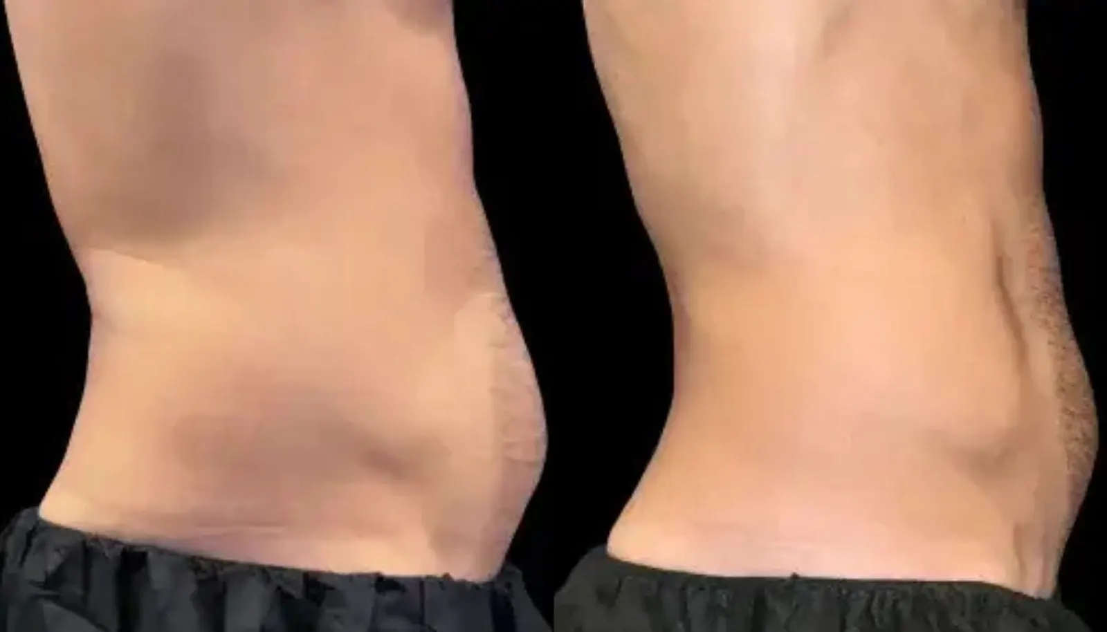 Emsculpt Neo — Before and After