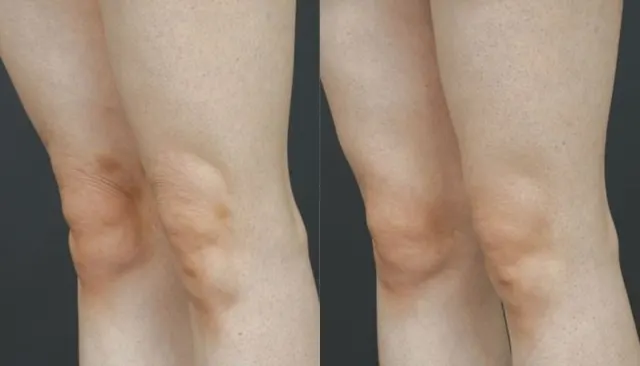 Everesse before and after