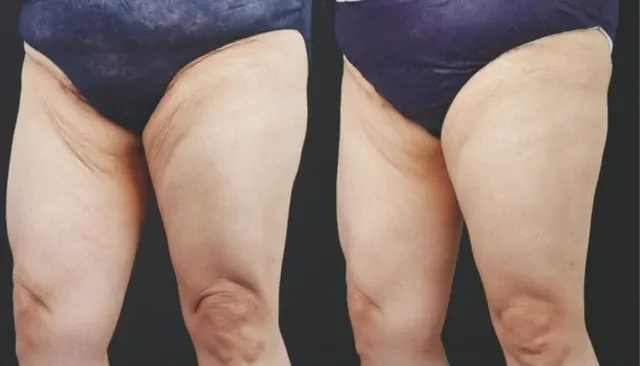 Everesse before and after