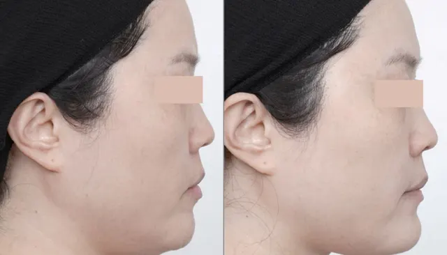 Everesse before and after