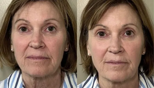 Everesse before and after
