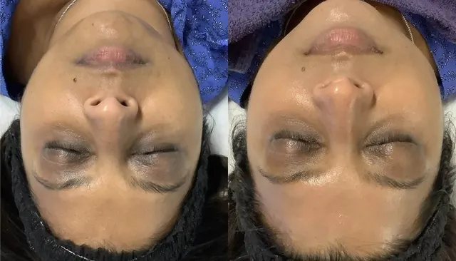HydraFacial before and after