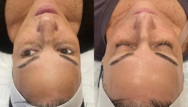 HydraFacial before and after
