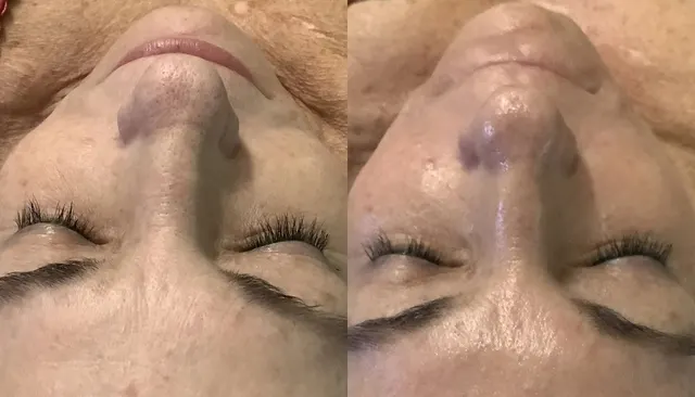 HydraFacial before and after