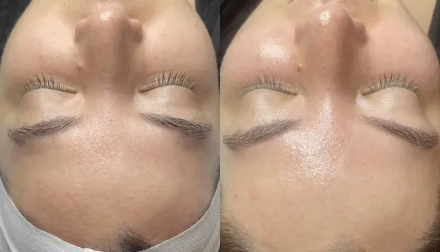 HydraFacial before and after
