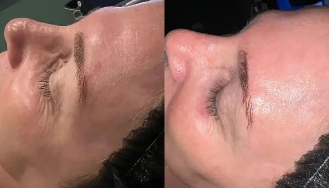 HydraFacial before and after