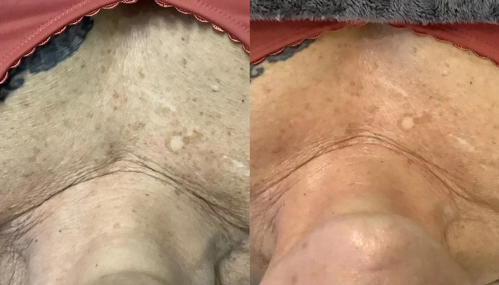 HydraFacial — Before and After