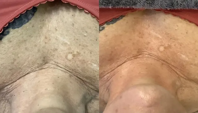 HydraFacial before and after