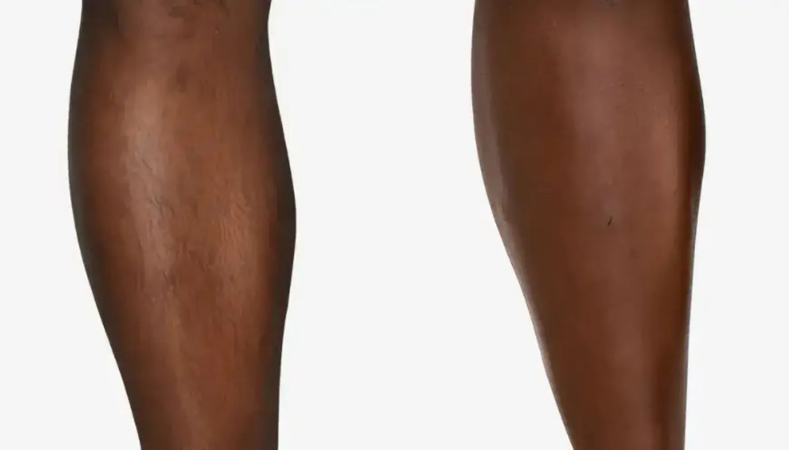Laser Hair Removal — Before and After