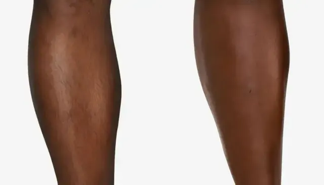 Laser Hair Removal before and after